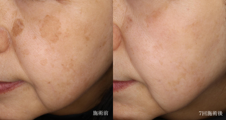 ピコおまかせプログラムとプラズマシャワーによる治療