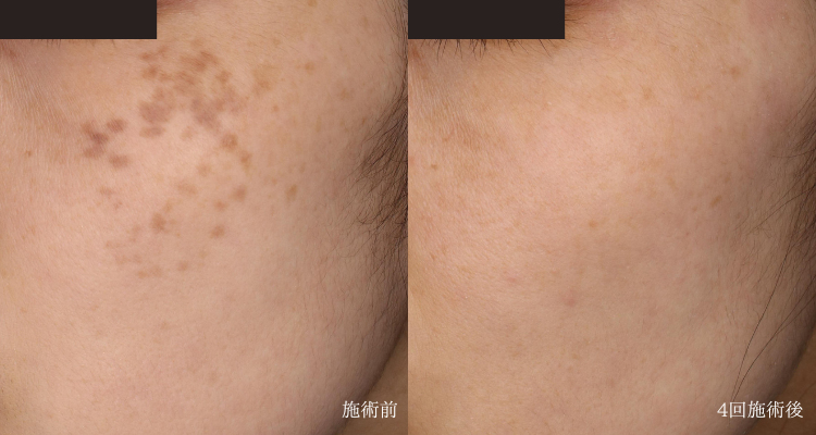 40代女性(治療名:ADMのピコレーザー)