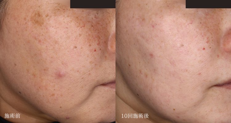 40代女性(治療名：ピコおまかせプログラムとプラズマシャワーによる治療)