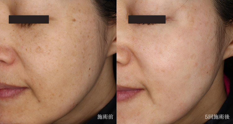 ピコおまかせプログラムとピコトーニングによる治療