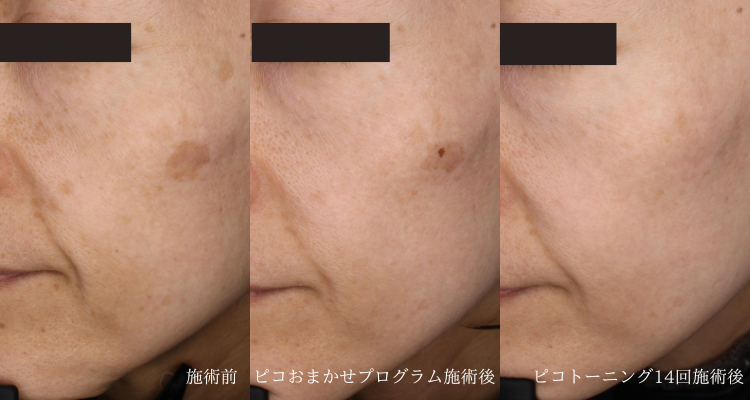 40代女性(治療名:ピコおまかせプログラムとピコトーニングによる治療)
