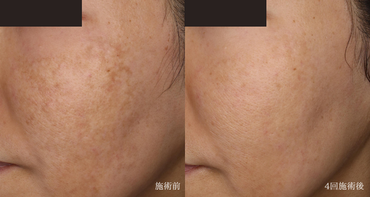 40代女性(治療名:肝斑のプラズマシャワー)