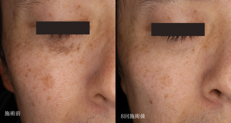 40代男性(治療名:太田母斑へのピコレーザー、肝斑へのプラズマシャワーによる治療)