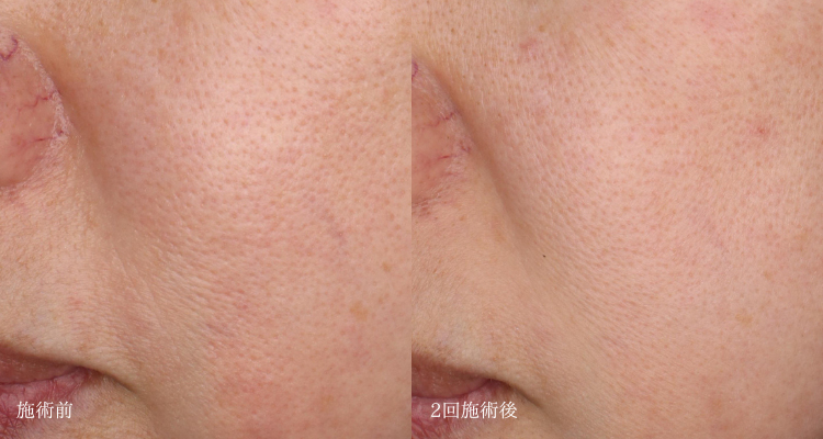 症例5：毛穴の開き