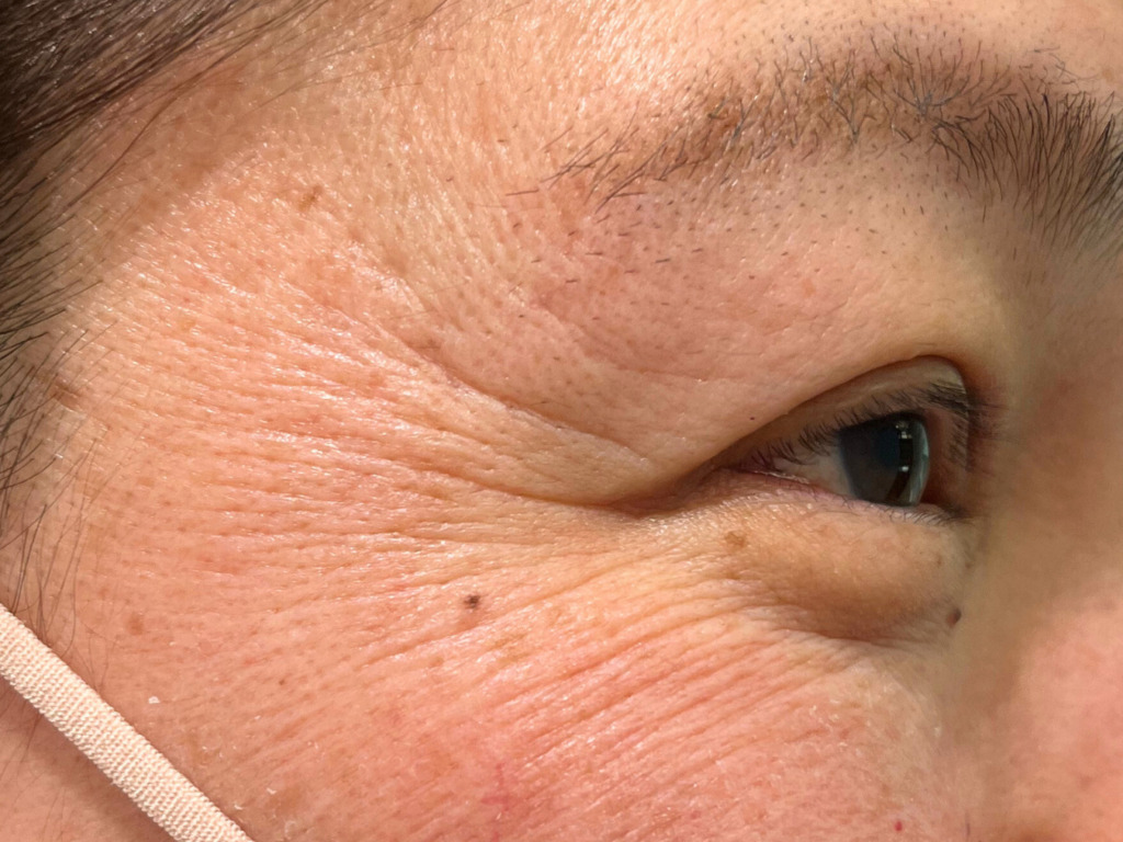 アラガン社 ボトックス®︎＋ヒアルロン酸注入 2本