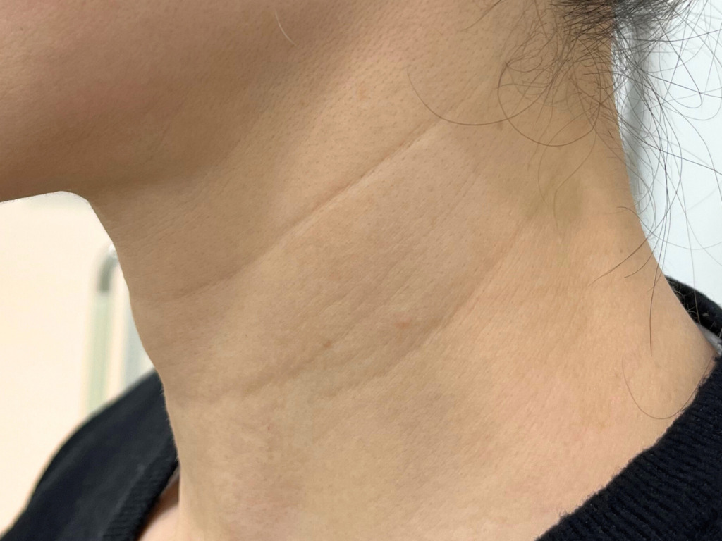 ②首トライフィルプロ　¥55,000