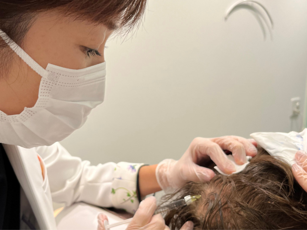 頭皮注入治療ヘアフィラー1本