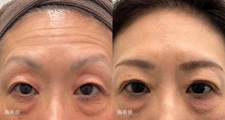 眼瞼下垂手術（タッキング法）＋額ボトックス注入