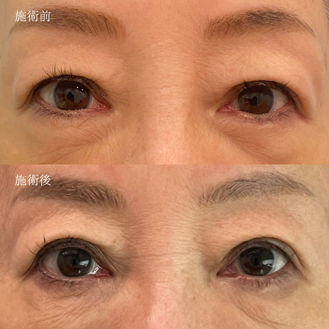 二重埋没直視下挙筋法 Gold（3線留め）