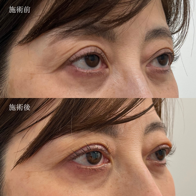 眼瞼下垂症手術