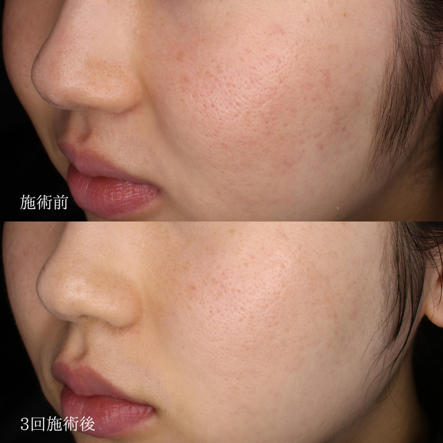 毛穴の開き(治療名：ダーマペン)