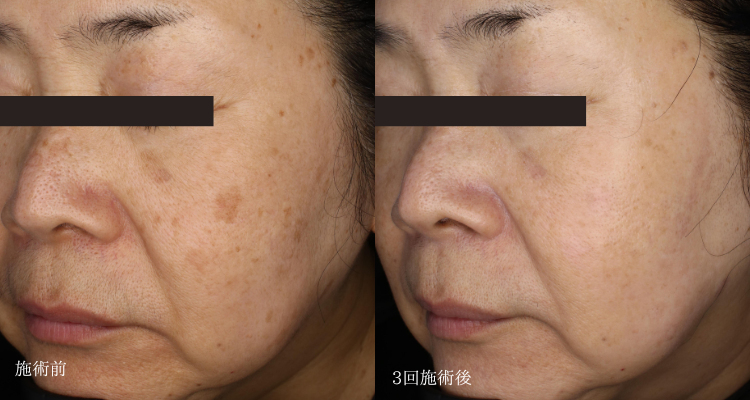 しみ取り(治療名：ピコトーニング)