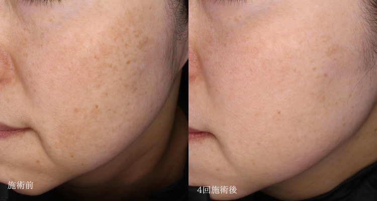 しみ取り(治療名：プラズマシャワー)