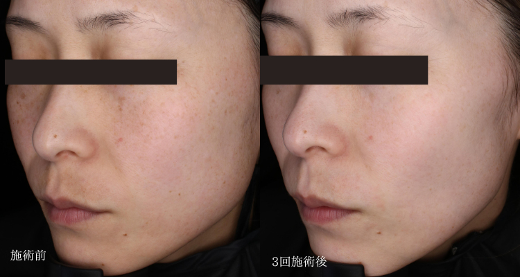 しみ取り(治療名：ピコトーニング)