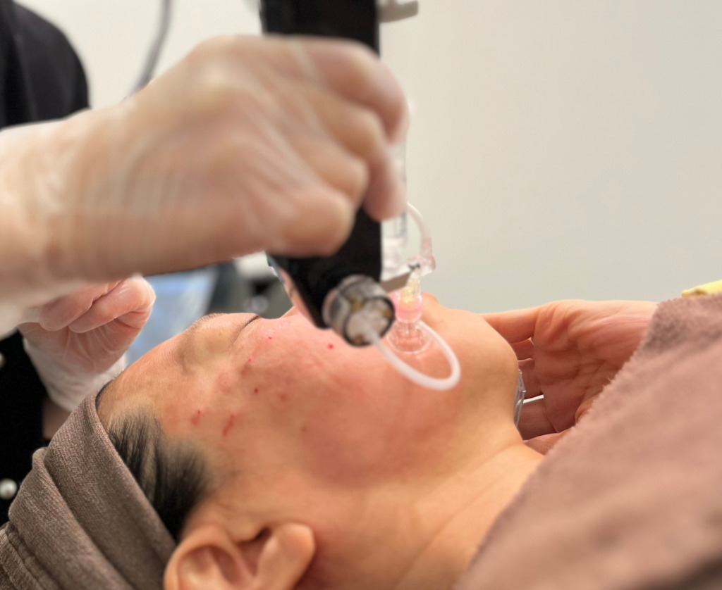 トライフィルプロスネコス または レヌボル注入