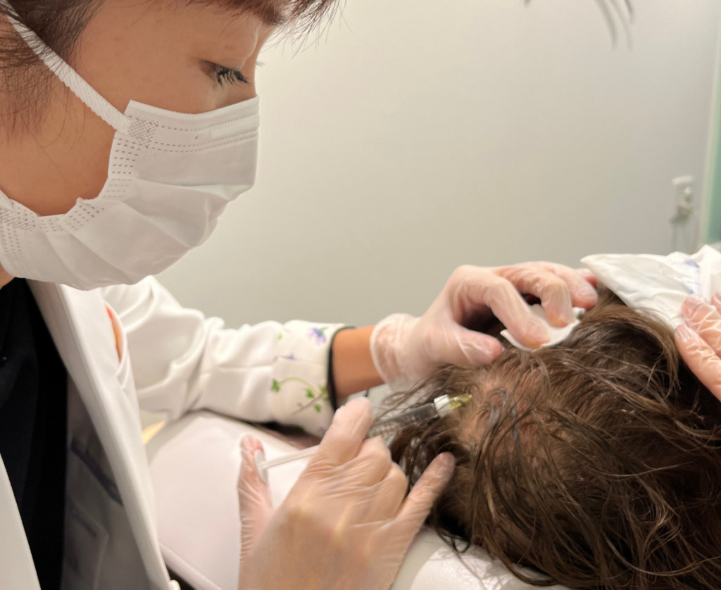 ヘアフィラー頭皮注入治療（メソセラピー）