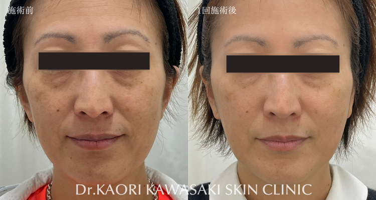 たるみ（マリオネットライン）改善(治療名：ヒアルロン酸注入)