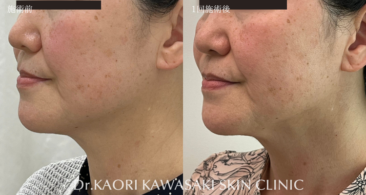 たるみ改善、リフトアップ(治療名：ヒアルロン酸注入)