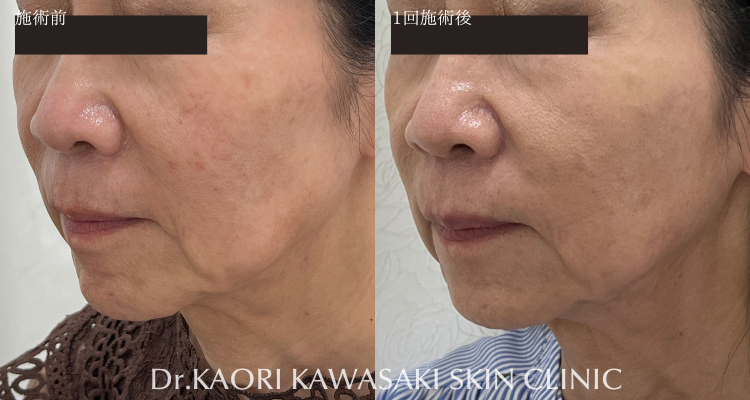 頬コケ、ほうれい線改善(治療名：ヒアルロン酸注入)