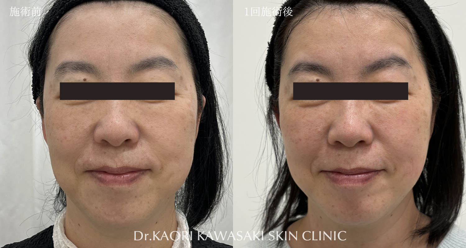 40代女性C5  たるみ改善、リフトアップ(治療名：ヒアルロン酸注入)