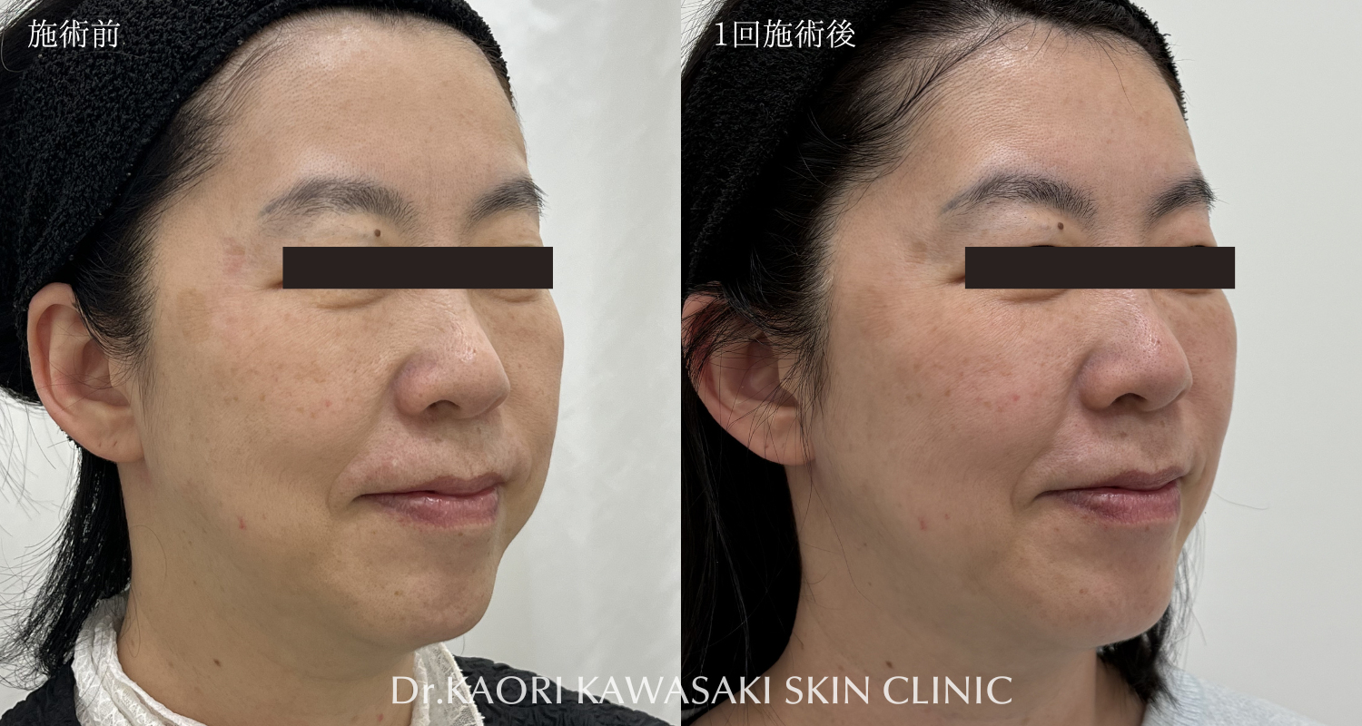 40代女性：たるみ改善、リフトアップ(治療名：ヒアルロン酸注入)