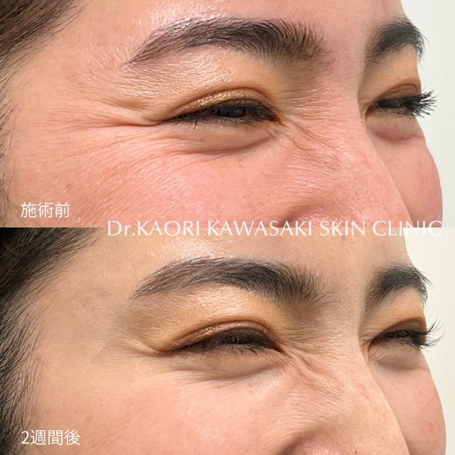 目尻のシワ(治療名：ボトックス®注入)