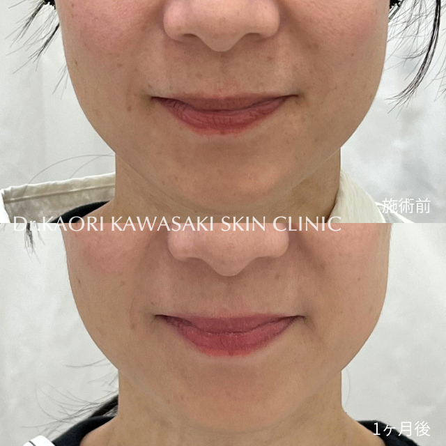 エラ(治療名：ボトックス®注入)