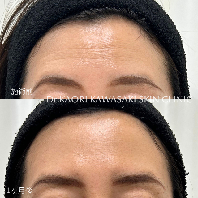 おでこのシワ(治療名：ボトックス®注入)