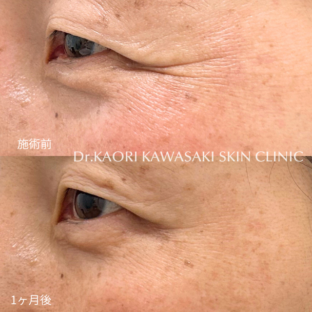 目尻のシワ（ボトックス®注入）