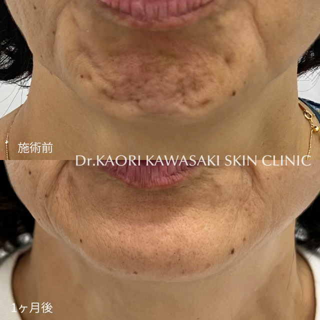 あごのシワ（ボトックス®注入）