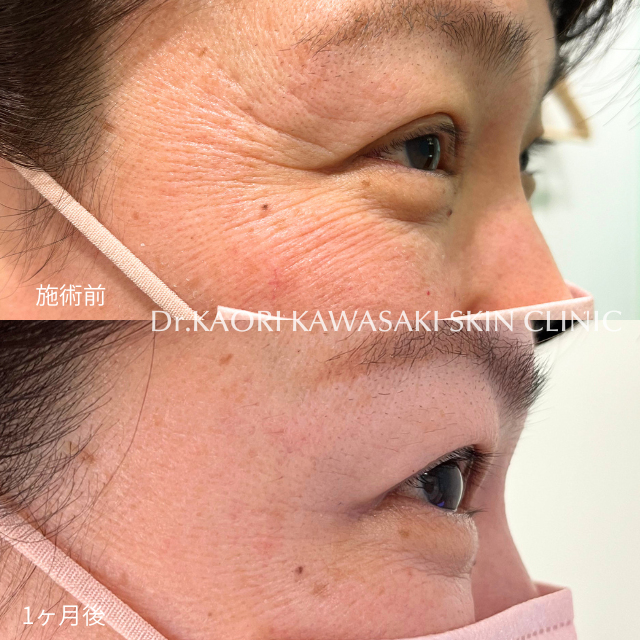 目尻のシワ（ボトックス®注入）