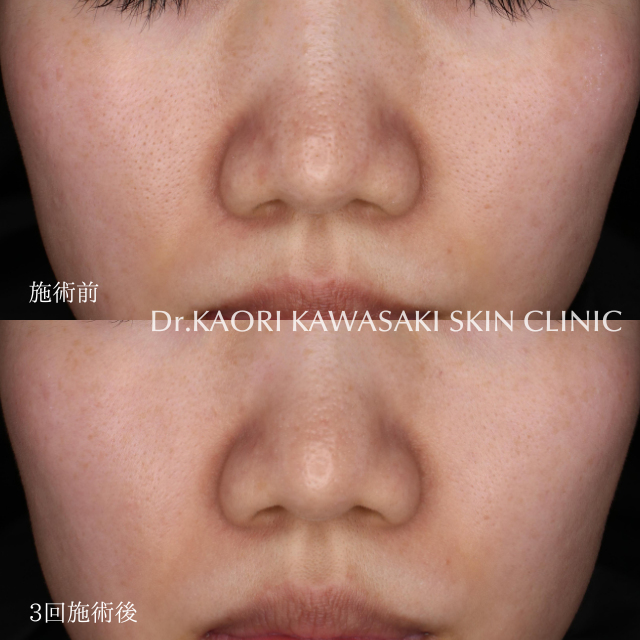 毛穴の開き(治療名：ペプタキセル)