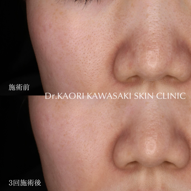 毛穴の開き(治療名：ペプタキセル)
