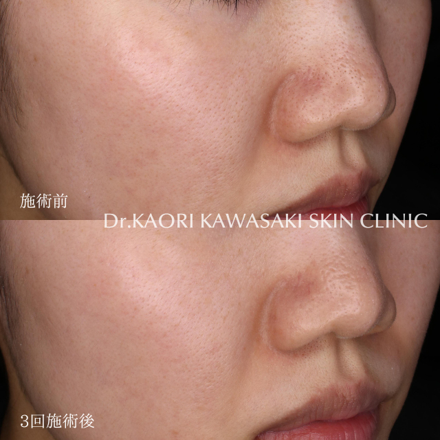 毛穴の開き(治療名：ペプタキセル)