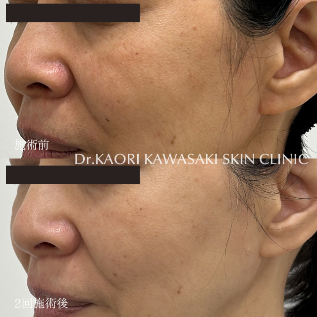 50代女性：レヌボル注入によるくすみ改善(治療名：レヌボル)