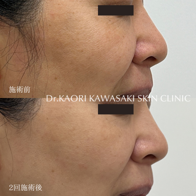 50代女性：レヌボル注入による小ジワ改善(治療名：レヌボル)