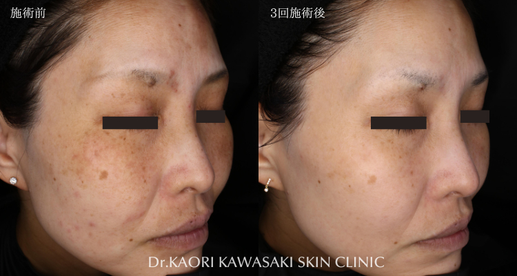 50代女性：アトピー性皮膚炎によるかゆみ、赤み、炎症性色素沈着の改善(治療名：トライフィルプロ)