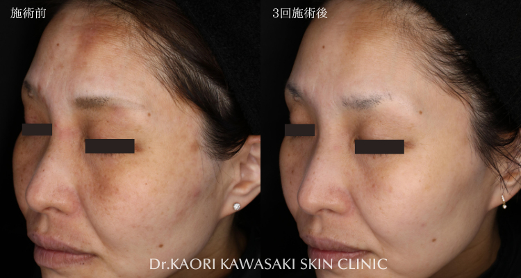 50代女性：アトピー性皮膚炎によるかゆみ、赤み、炎症性色素沈着の改善(治療名：トライフィルプロ)