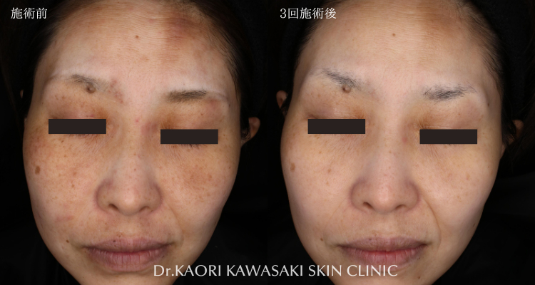 50代女性：アトピー性皮膚炎によるかゆみ、赤み、炎症性色素沈着の改善(治療名：トライフィルプロ)