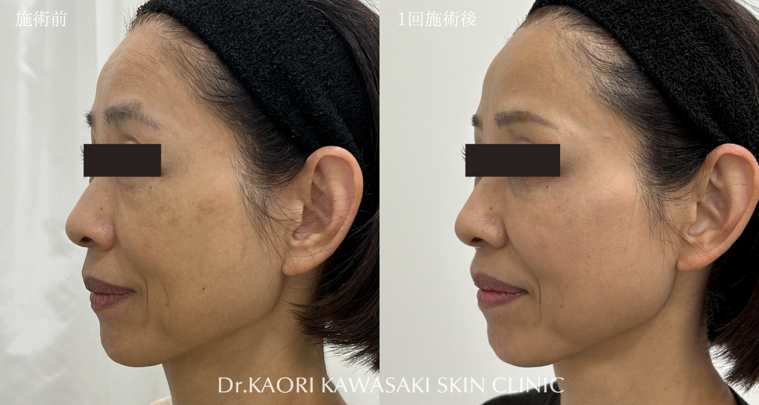 50代女性：たるみ改善・リフトアップ(治療名：ヒアルロン酸注入)