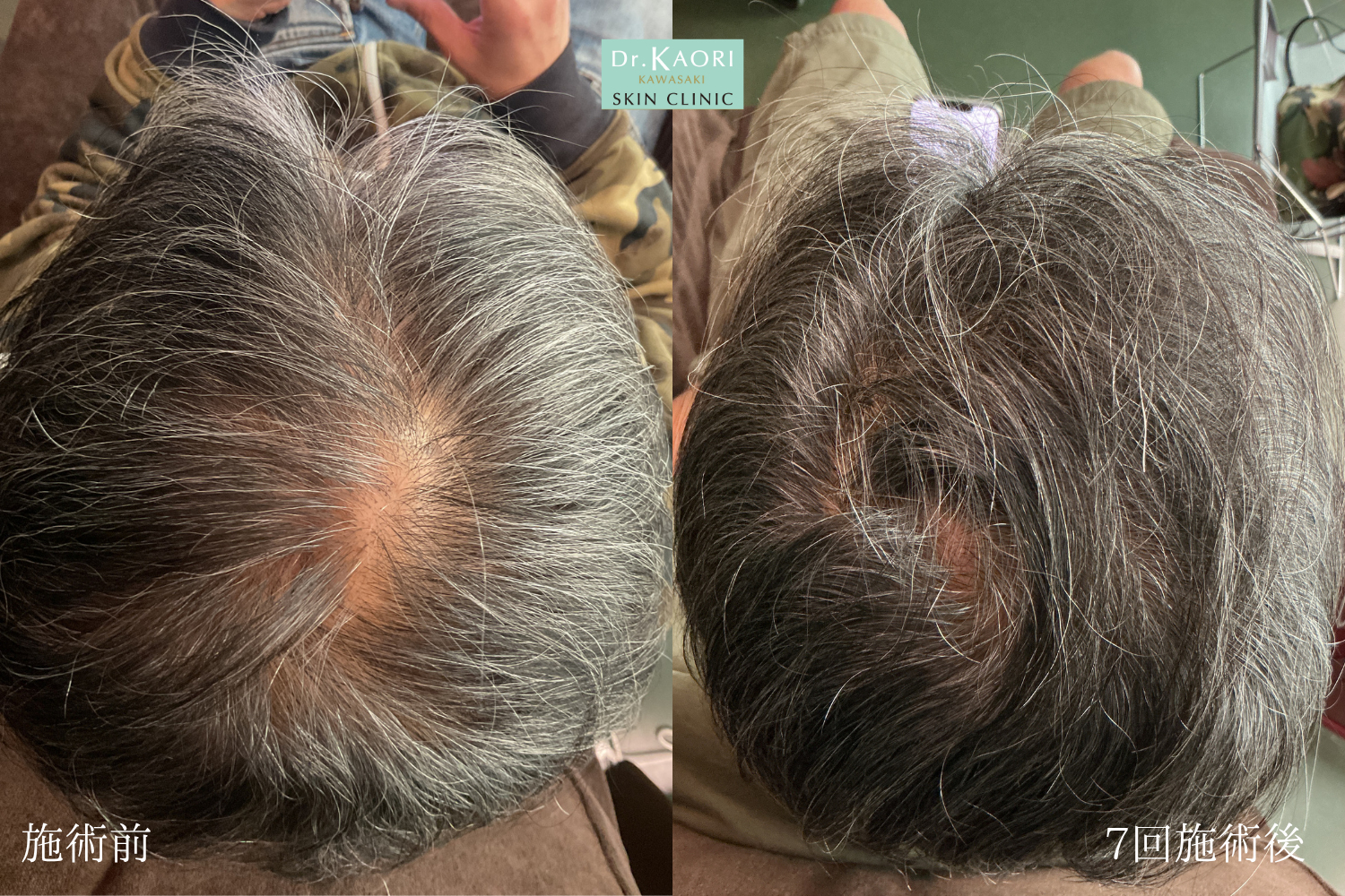 50代男性：薄毛治療(治療名：頭皮注入療法ヘアフィラー)