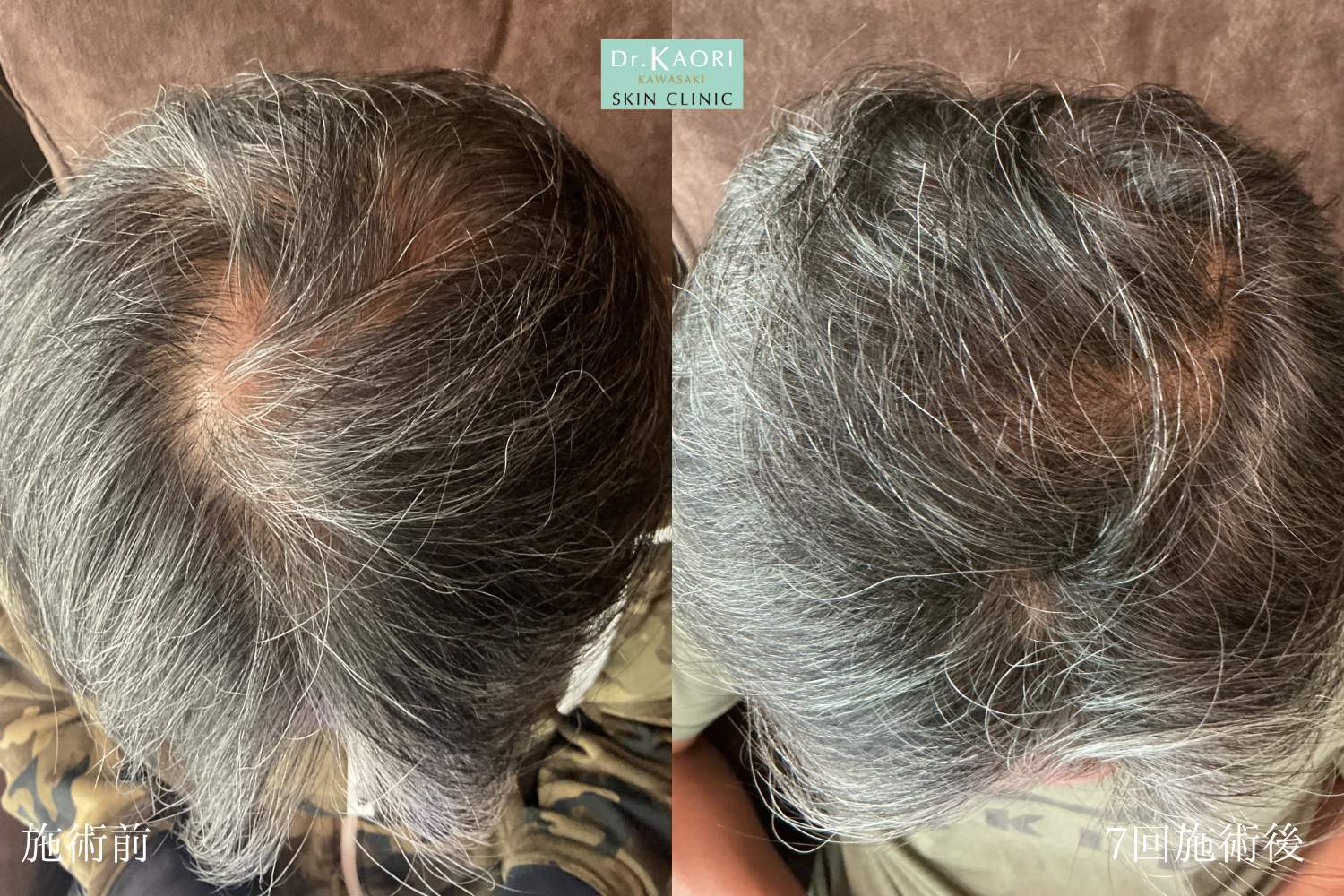50代男性:薄毛治療(治療名:頭皮注入療法ヘアフィラー)