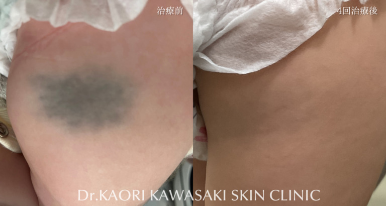 異所性蒙古斑の治療(治療名：ピコレーザーによる皮膚レーザー照射療法（保険適用）)