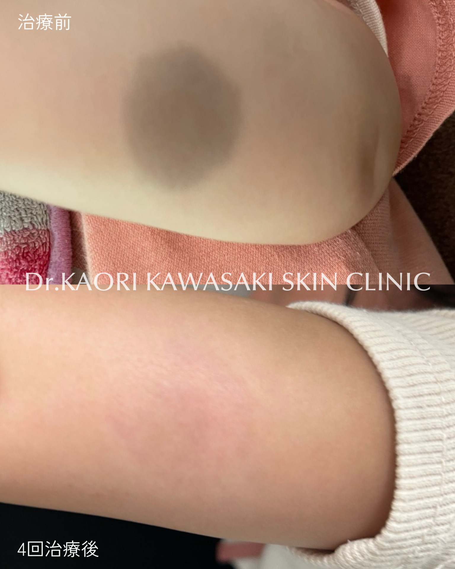 0歳6ヶ月(治療開始時)：異所性蒙古斑の治療(治療名：ピコレーザーによる皮膚レーザー照射療法（保険適用）)
