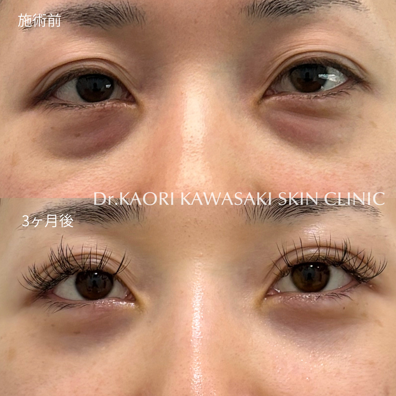 20代女性：クマ取り手術 (治療名：裏ハムラ法および二重埋没手術 (直視下拳筋法ゴールド3線留め))