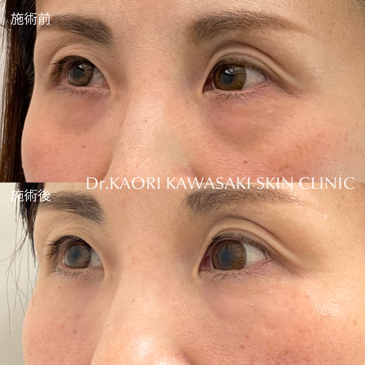 40代女性：クマ改善(治療名：ヒアルロン酸注入)