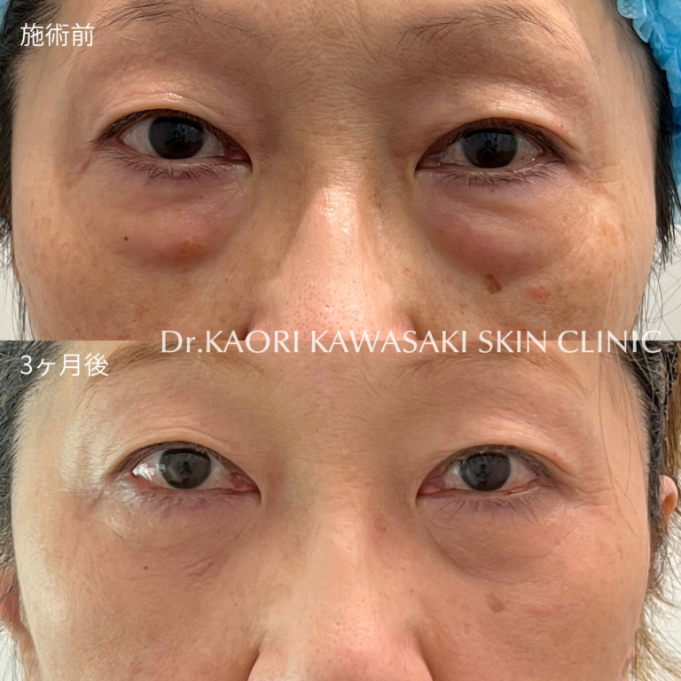 クマ取り手術 (治療名：裏ハムラ法・経結膜的眼窩脂肪除去術)