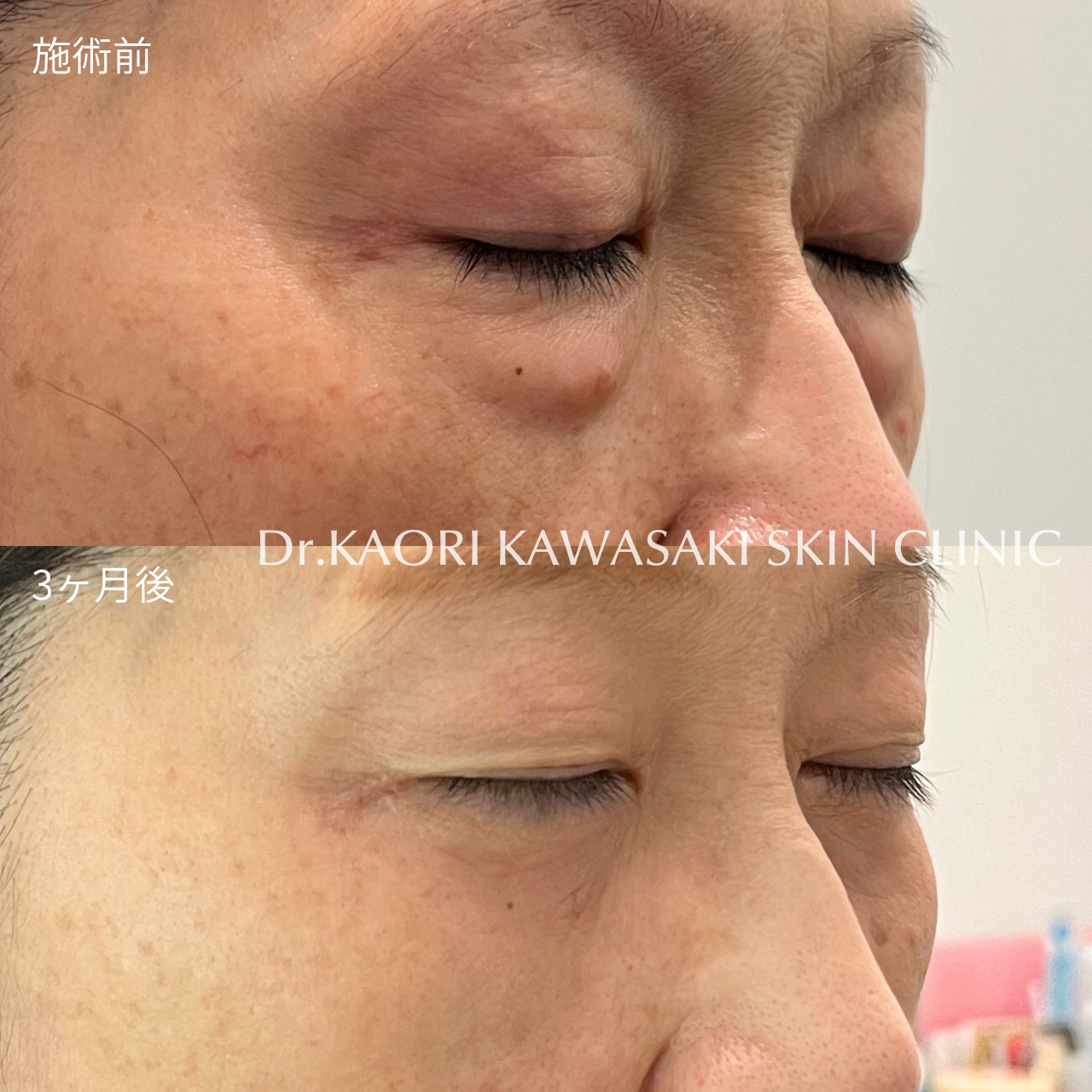 50代女性：クマ取り手術 (治療名：裏ハムラ法・経結膜的眼窩脂肪除去術)