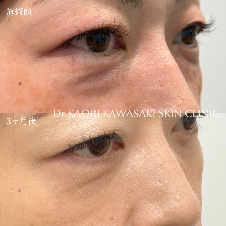 クマ取り手術 (治療名：裏ハムラ法・経結膜的眼窩脂肪除去術)