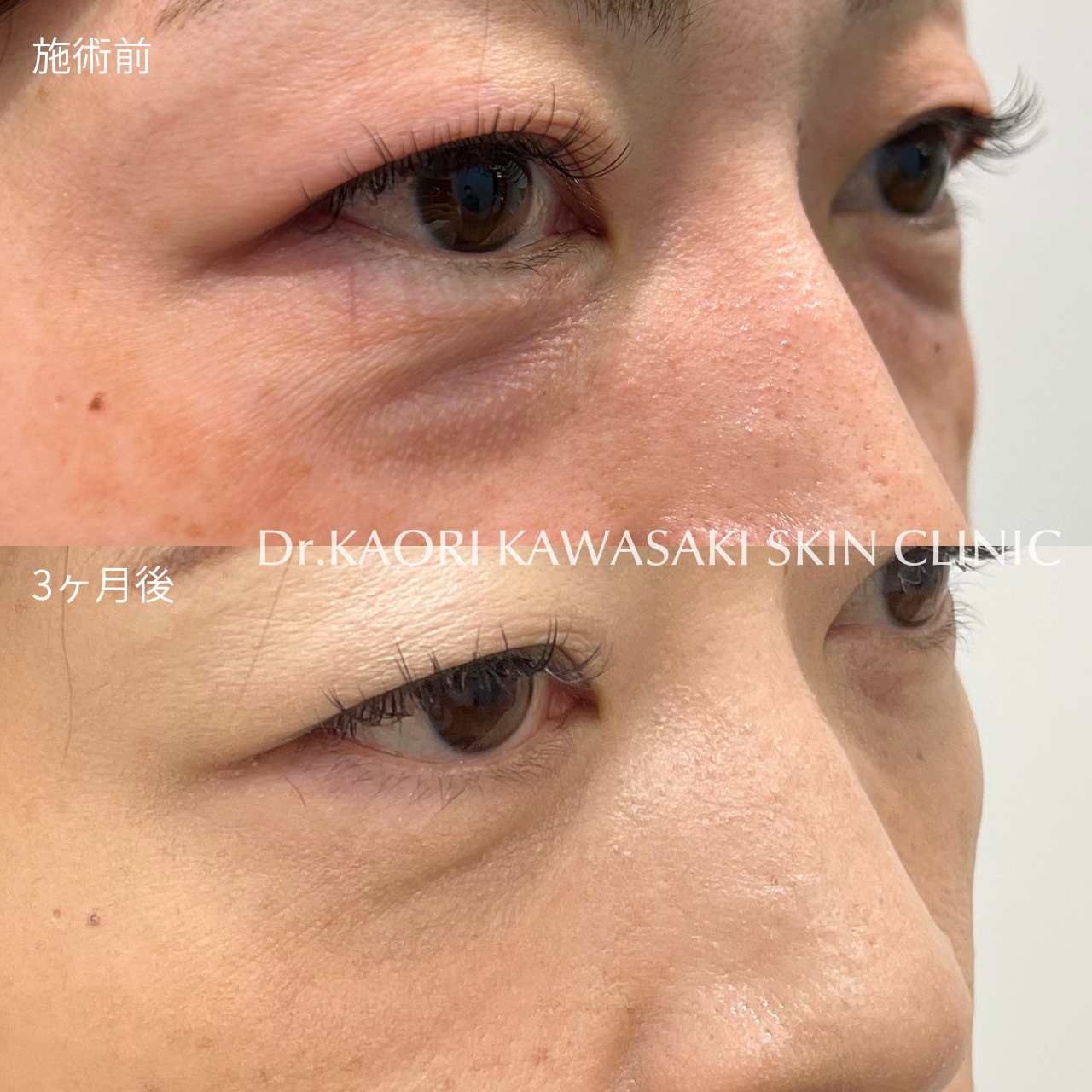 40代女性:クマ取り手術 (裏ハムラ法・経結膜的眼窩脂肪除去術)